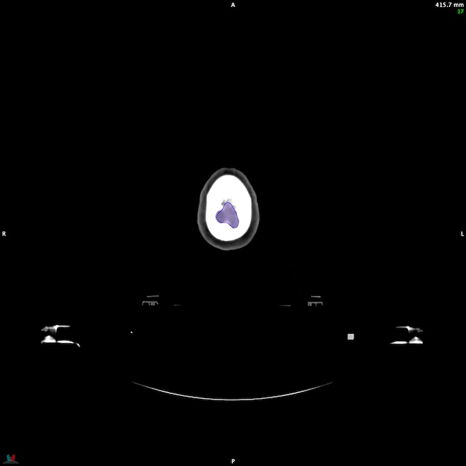 Automatic Contouring/Segmentation Demo