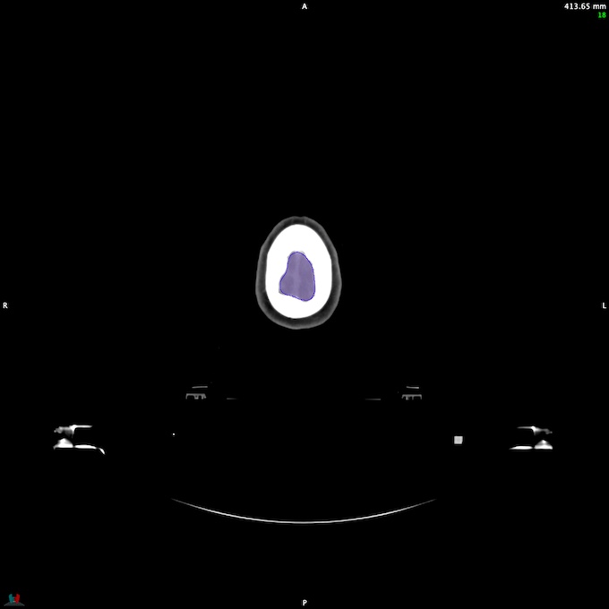 Automatic Contouring/Segmentation Demo
