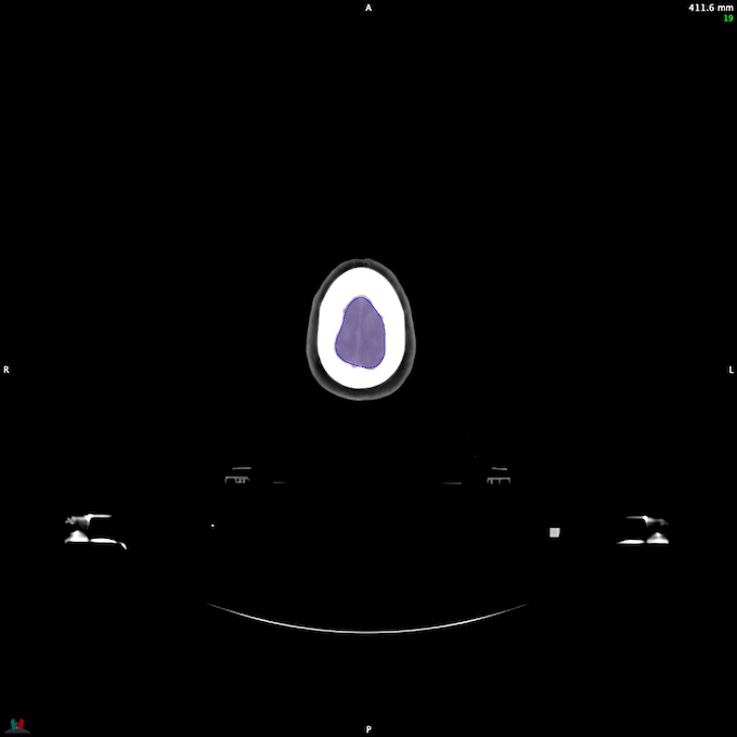 Automatic Contouring/Segmentation Demo
