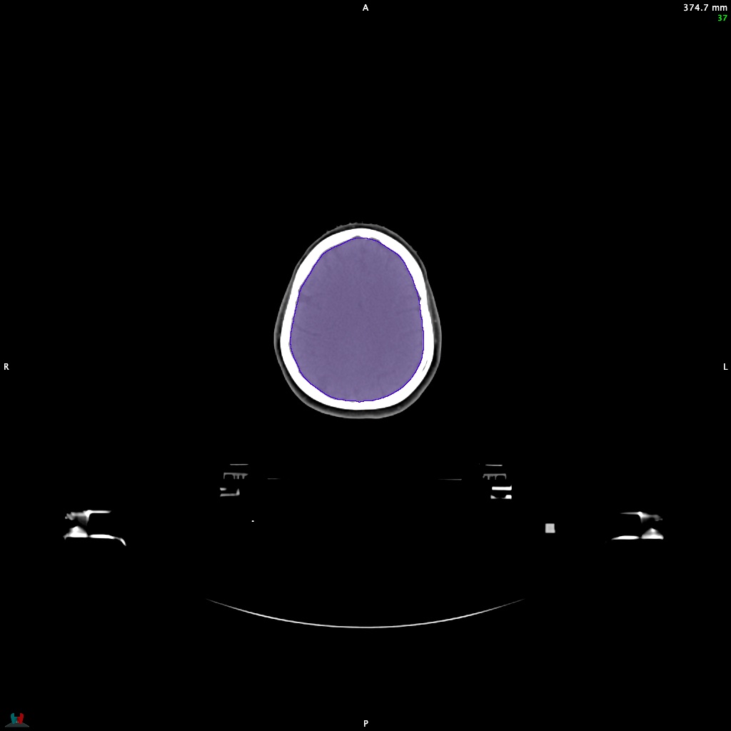 Automatic Contouring/Segmentation Demo