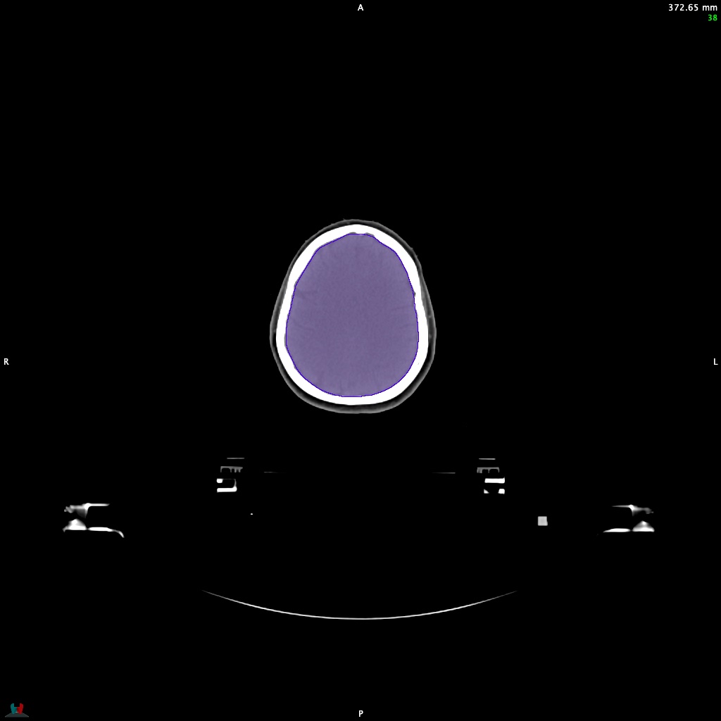 Automatic Contouring/Segmentation Demo