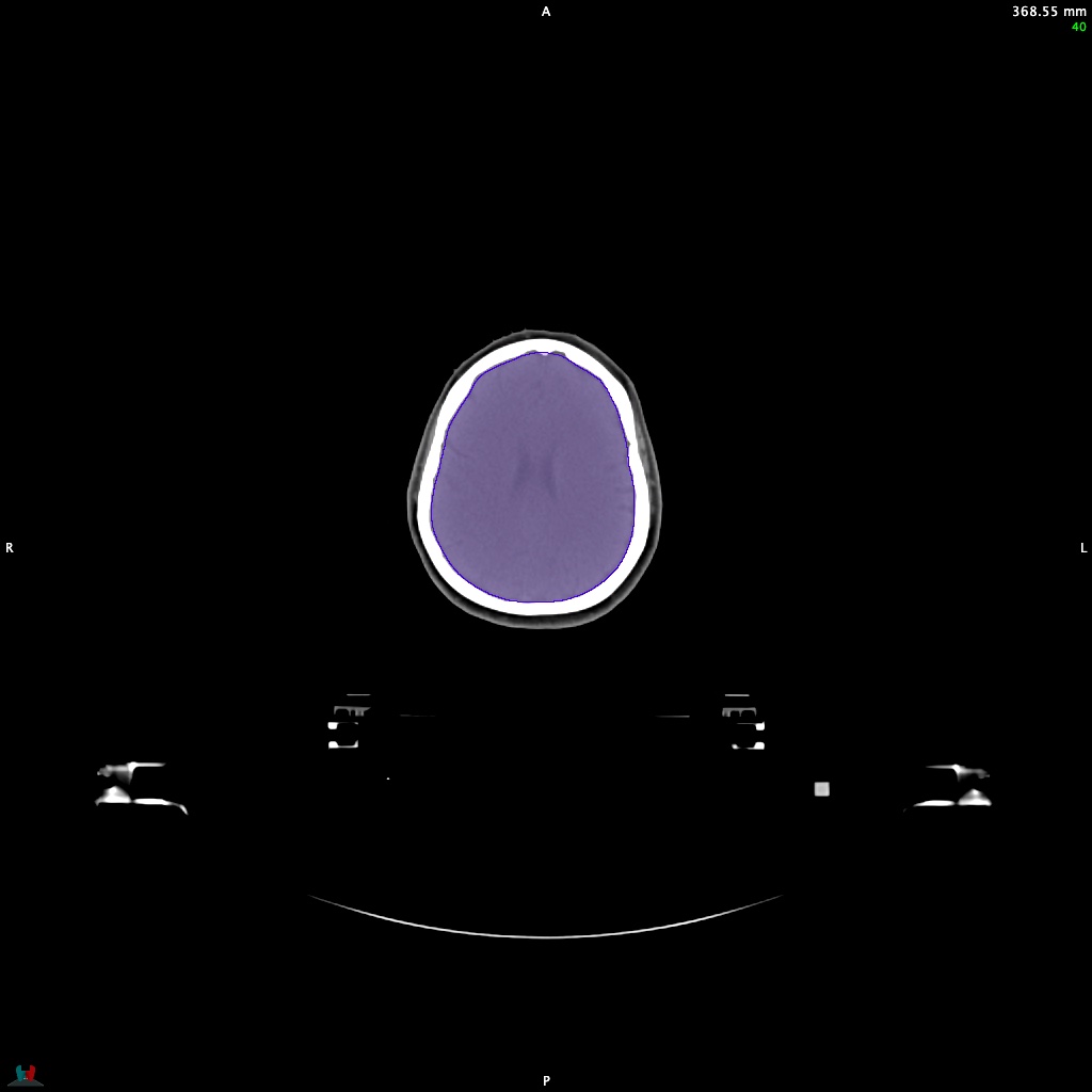 Automatic Contouring/Segmentation Demo