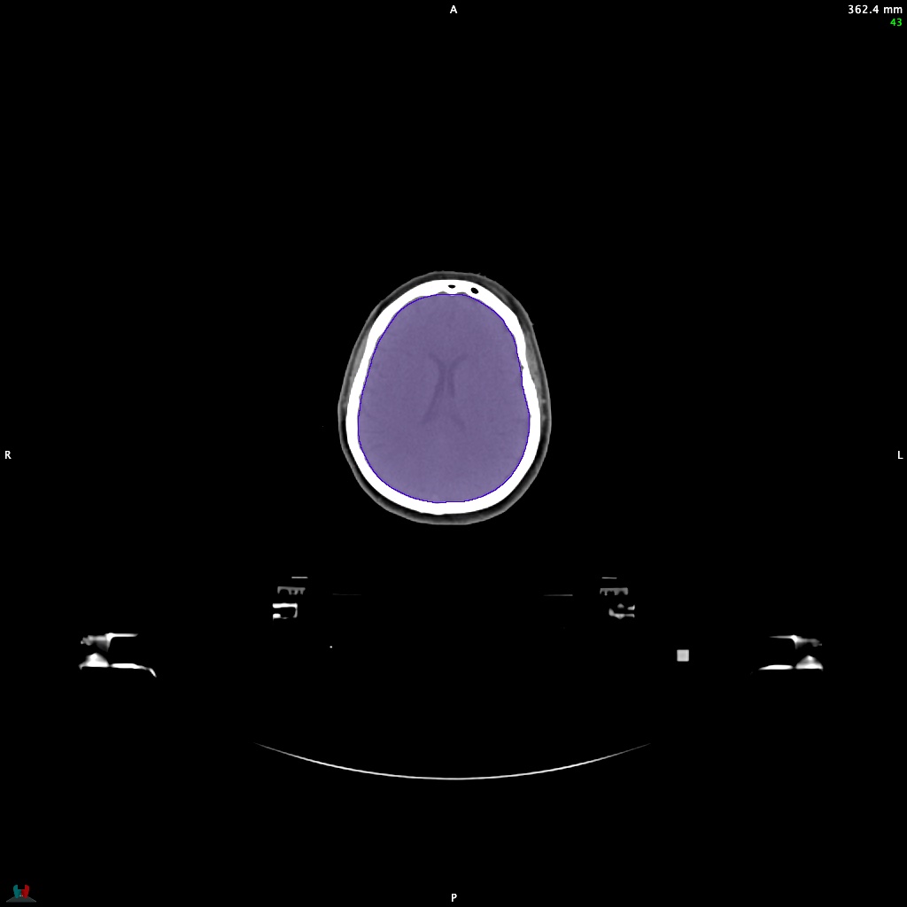 Automatic Contouring/Segmentation Demo