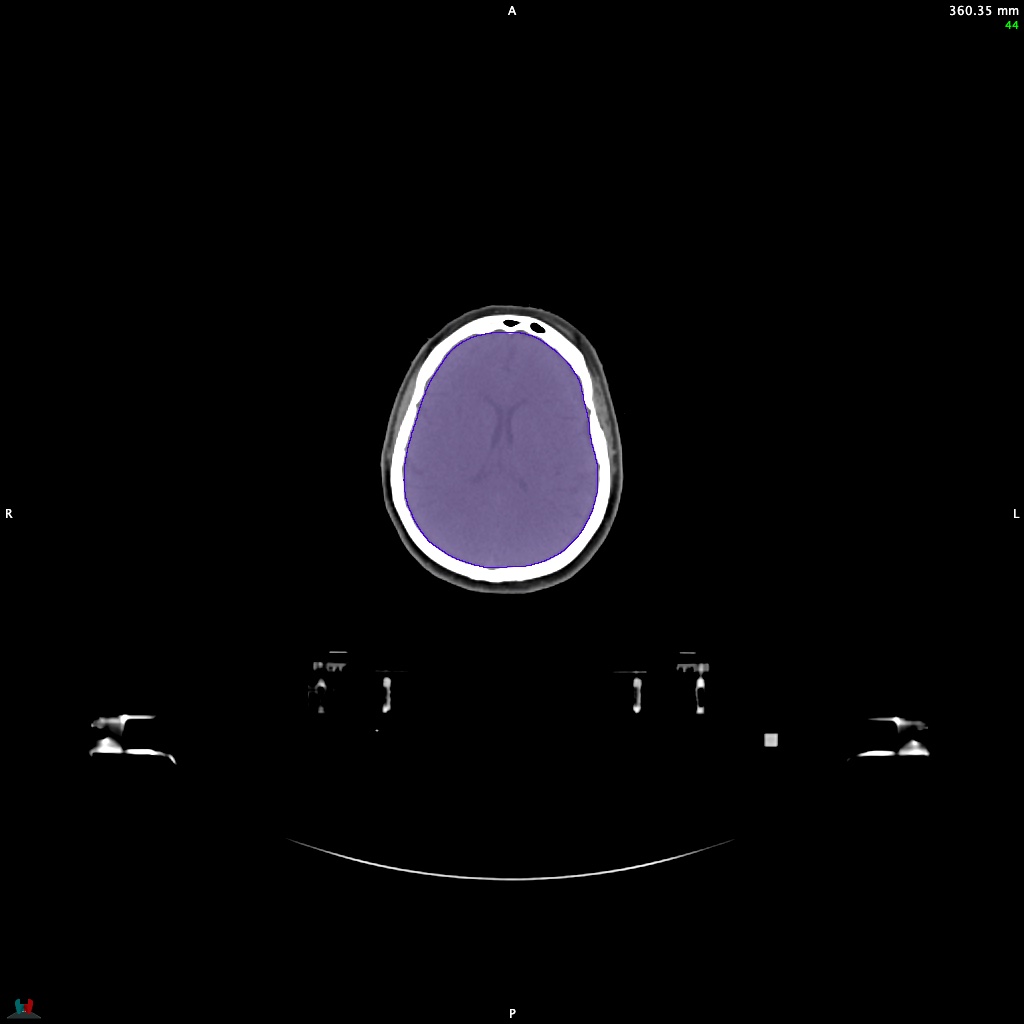 Automatic Contouring/Segmentation Demo