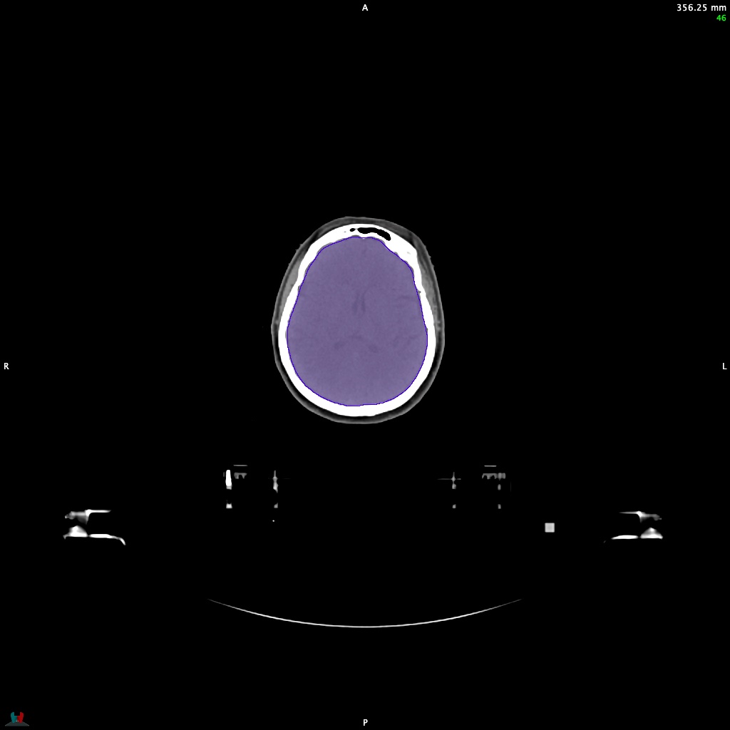 Automatic Contouring/Segmentation Demo