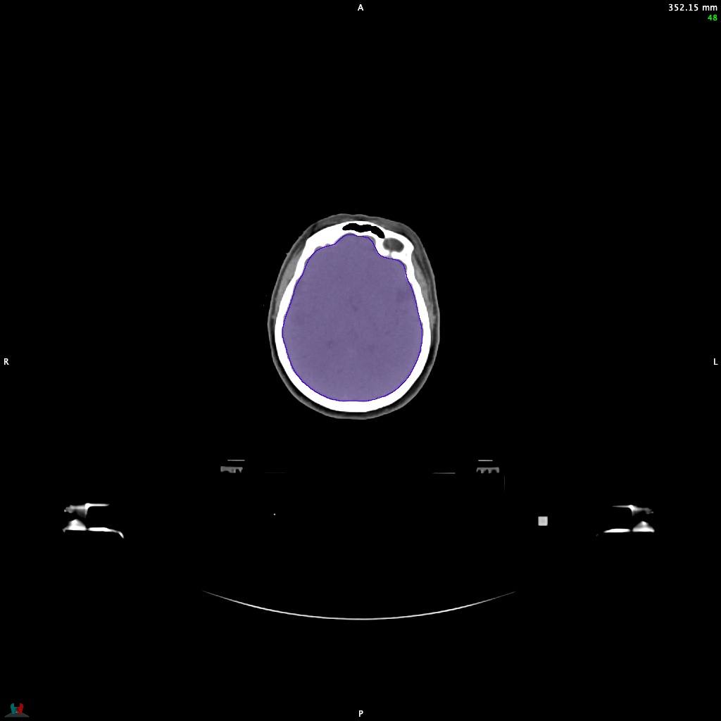 Automatic Contouring/Segmentation Demo