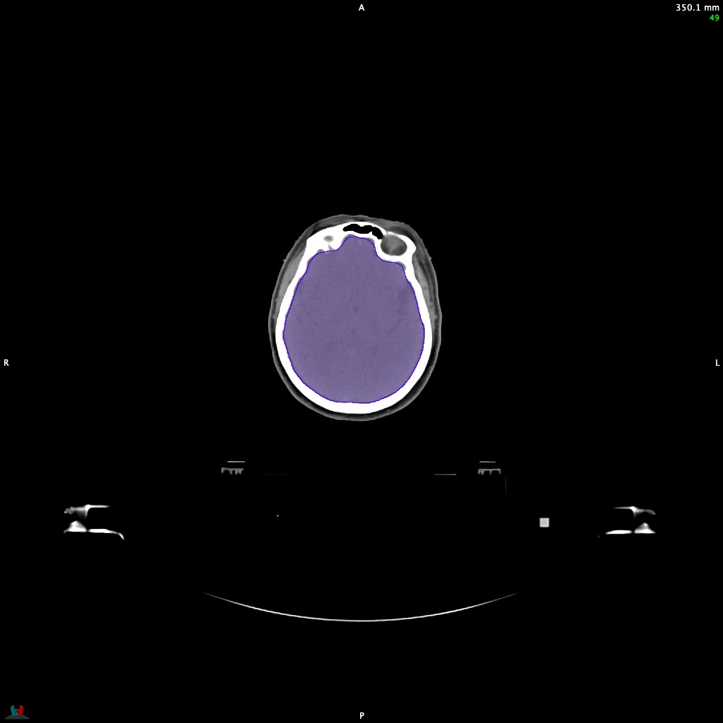 Automatic Contouring/Segmentation Demo