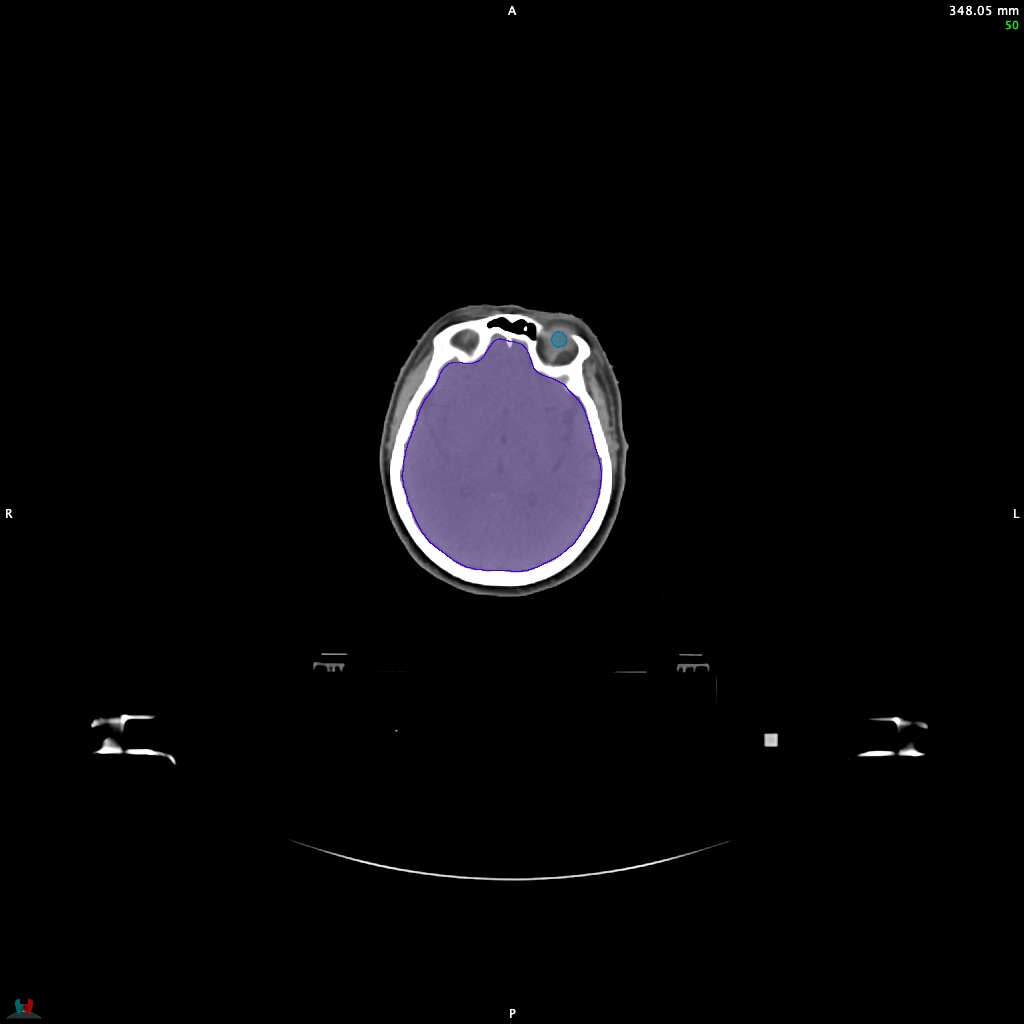 Automatic Contouring/Segmentation Demo