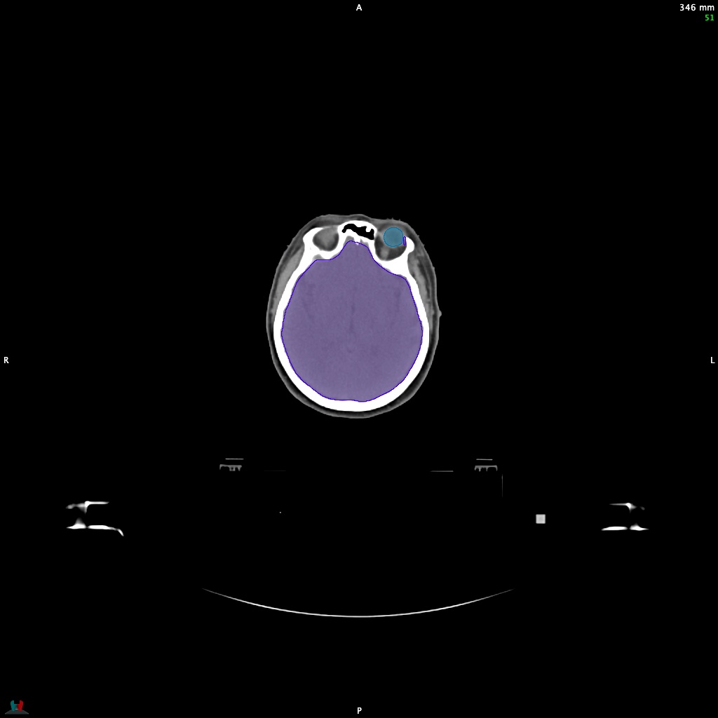 Automatic Contouring/Segmentation Demo
