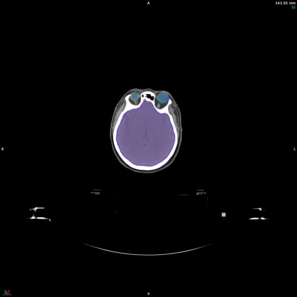 Automatic Contouring/Segmentation Demo