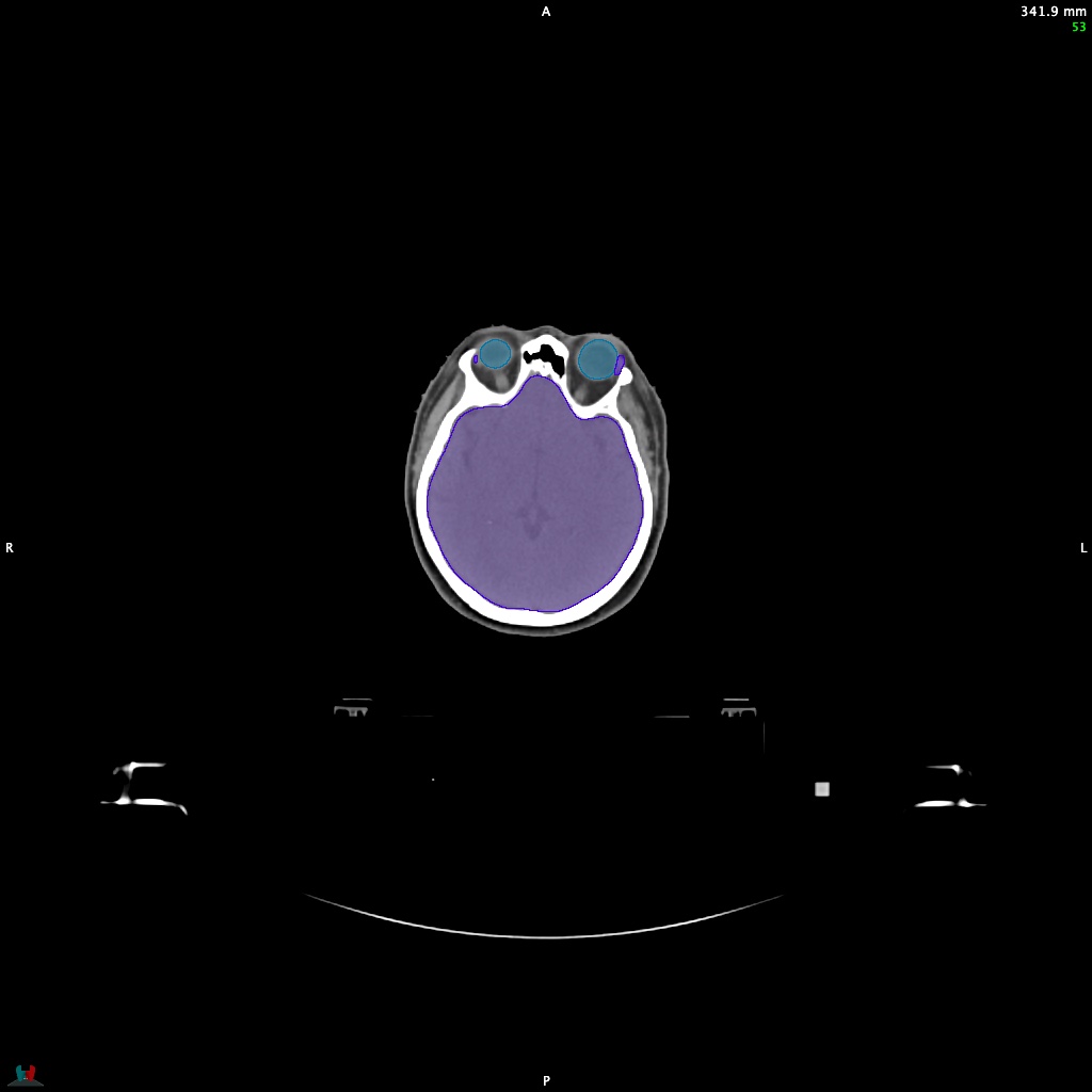 Automatic Contouring/Segmentation Demo