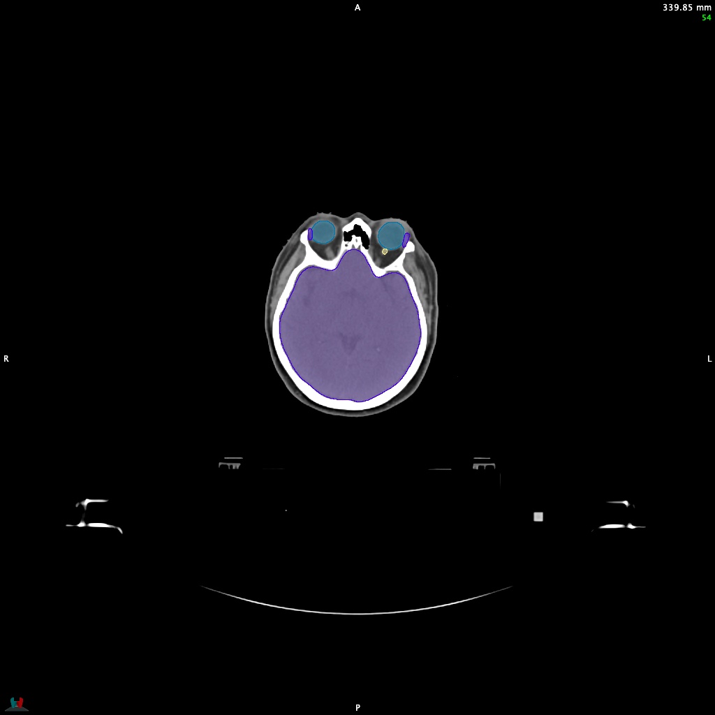 Automatic Contouring/Segmentation Demo