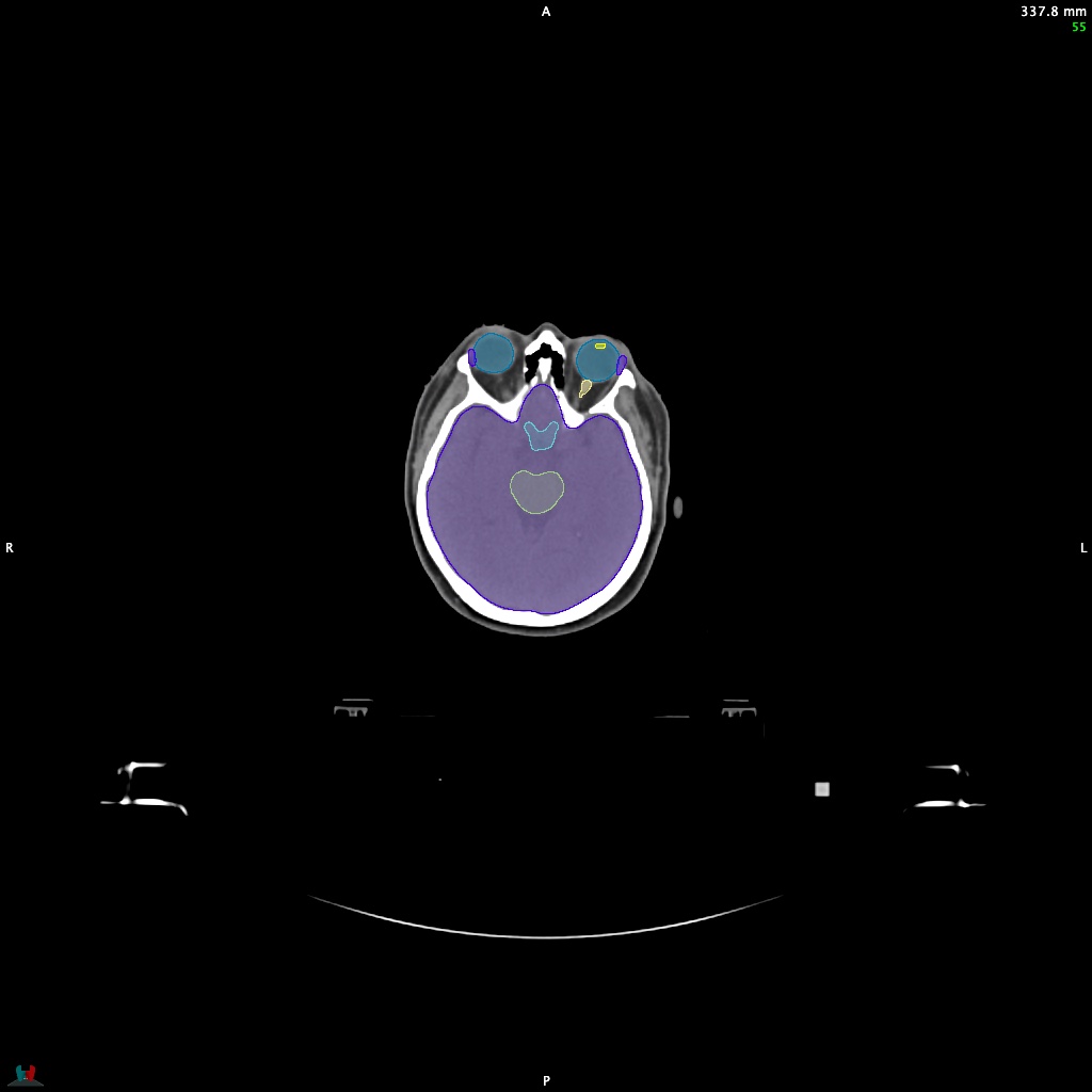 Automatic Contouring/Segmentation Demo