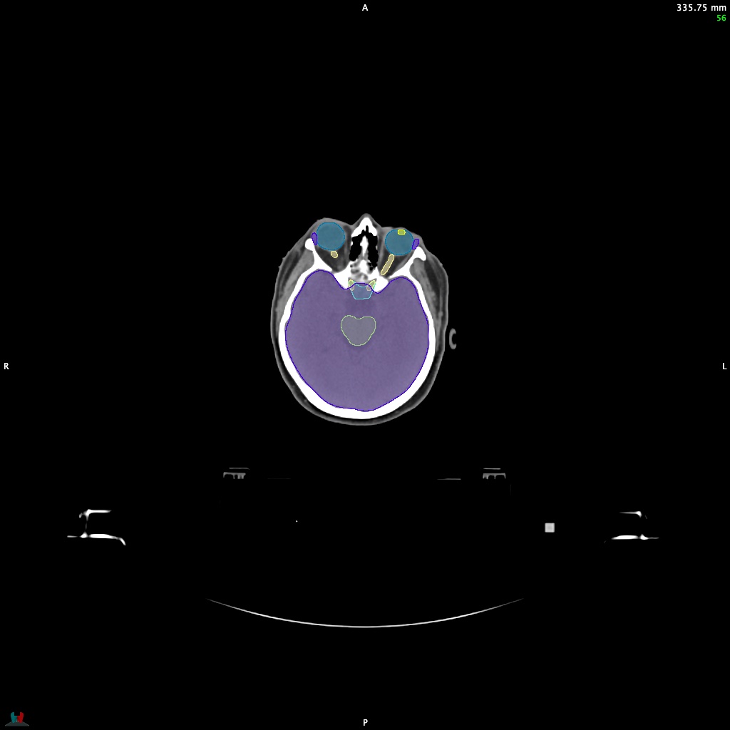Automatic Contouring/Segmentation Demo