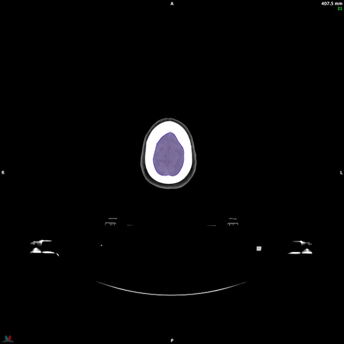 Automatic Contouring/Segmentation Demo