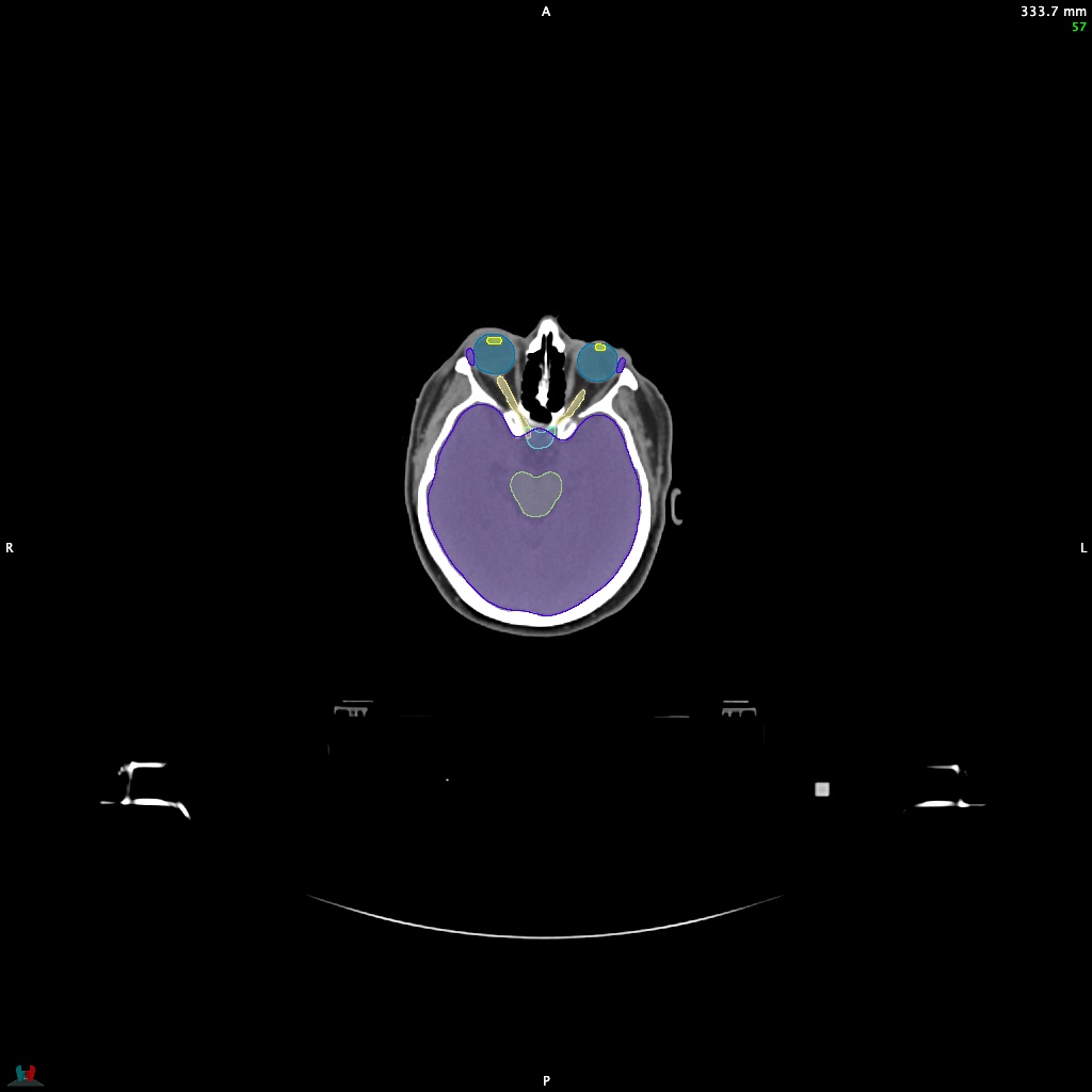 Automatic Contouring/Segmentation Demo