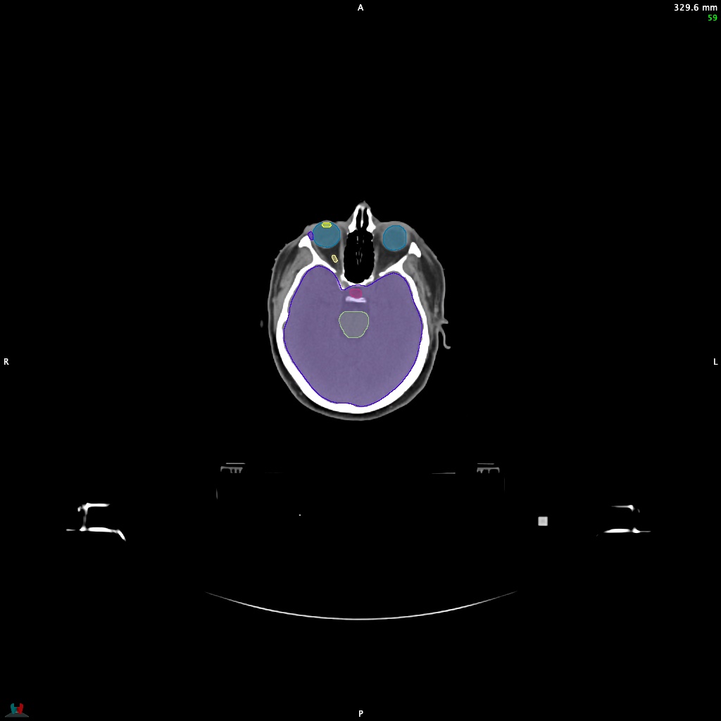 Automatic Contouring/Segmentation Demo