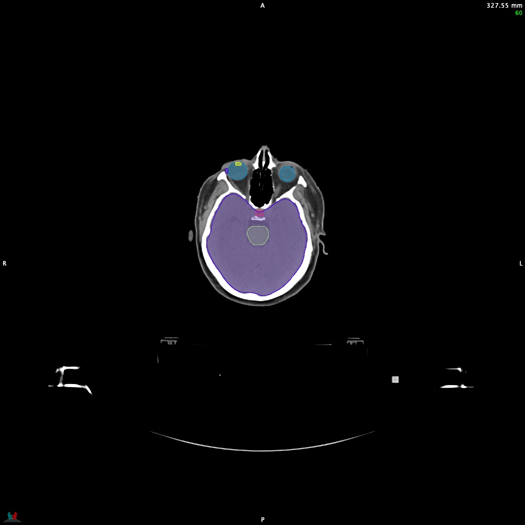 Automatic Contouring/Segmentation Demo