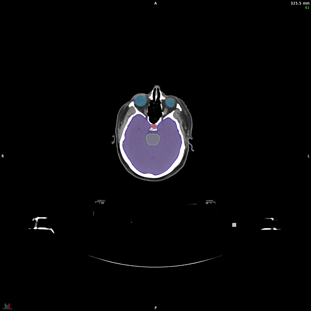 Automatic Contouring/Segmentation Demo