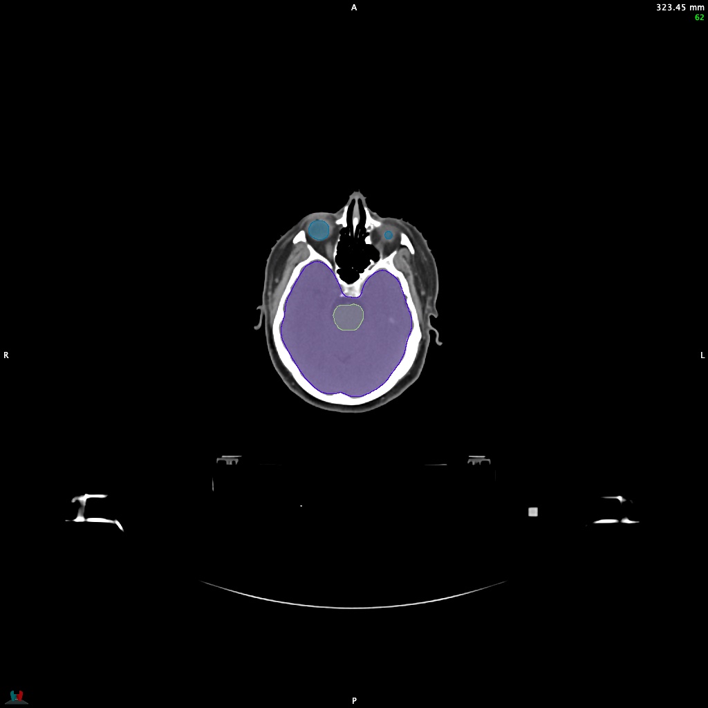 Automatic Contouring/Segmentation Demo