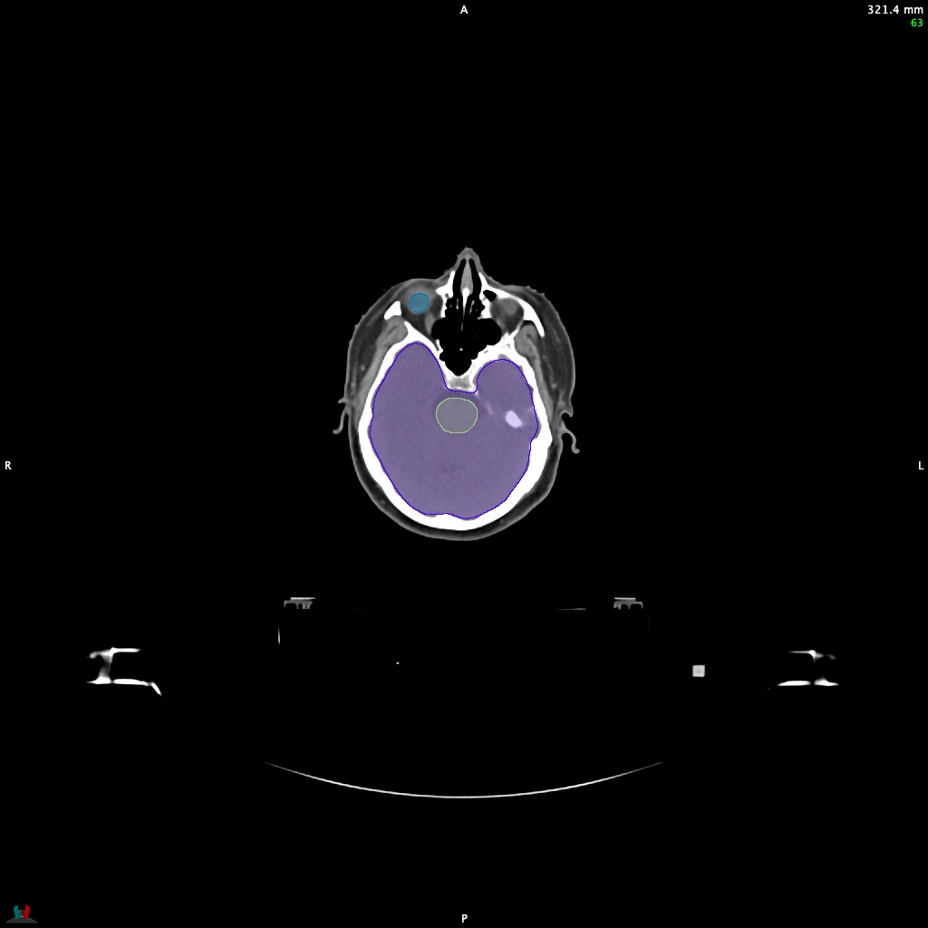Automatic Contouring/Segmentation Demo