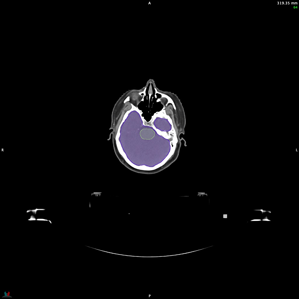 Automatic Contouring/Segmentation Demo