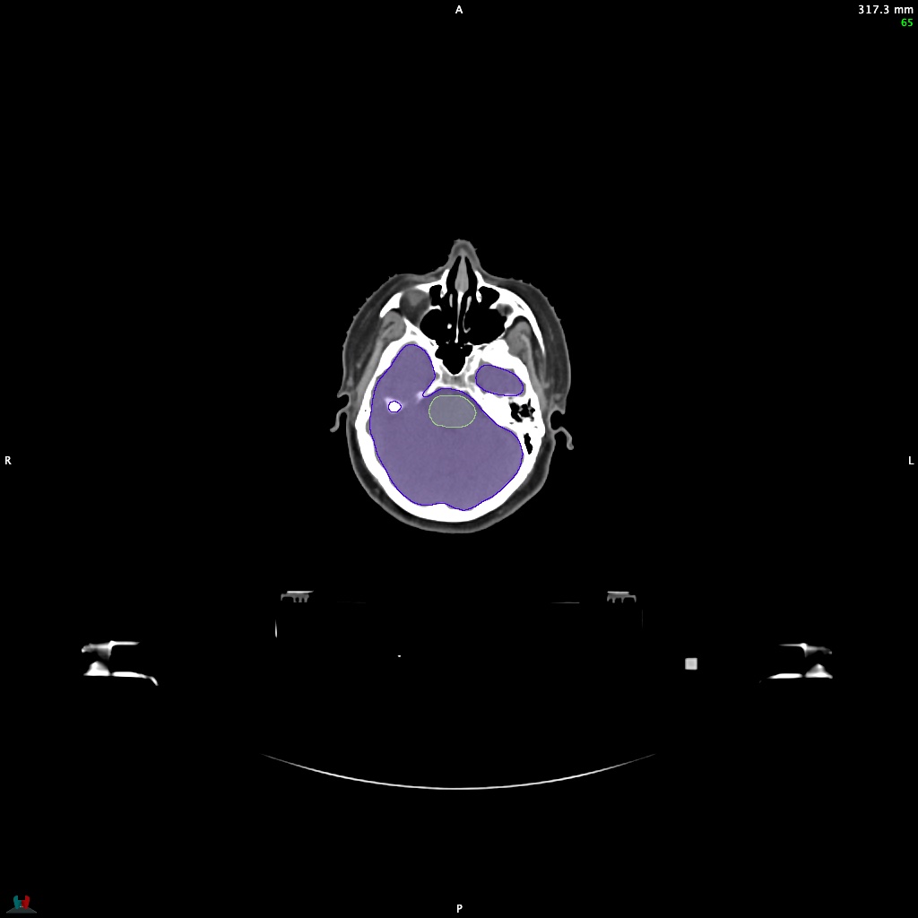 Automatic Contouring/Segmentation Demo