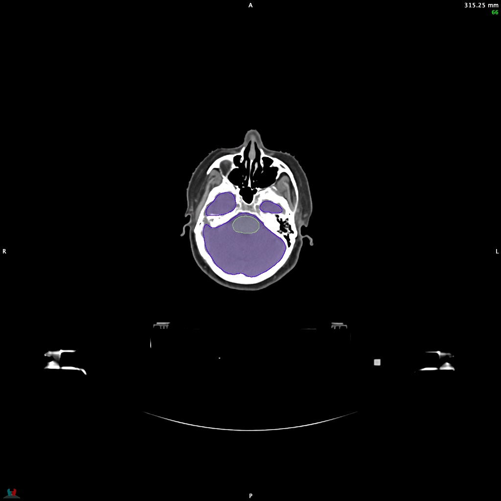 Automatic Contouring/Segmentation Demo