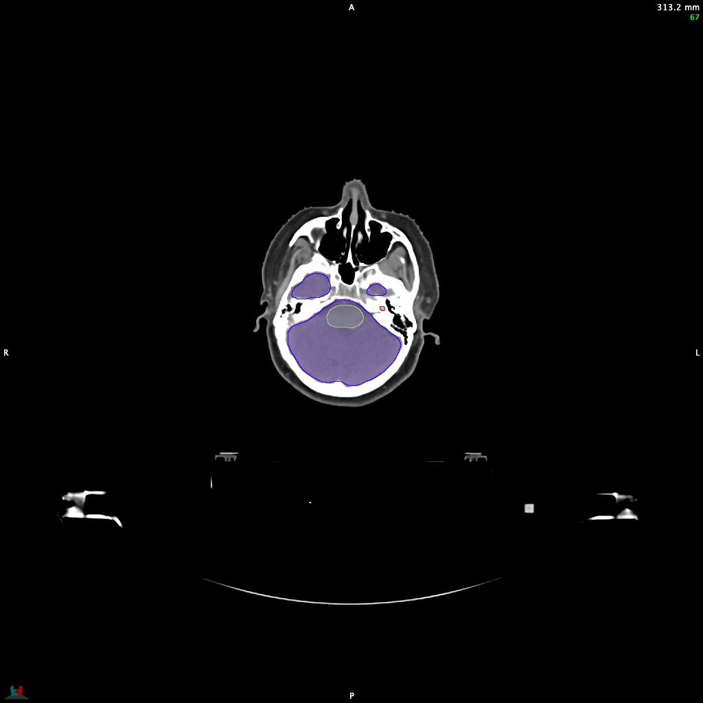 Automatic Contouring/Segmentation Demo