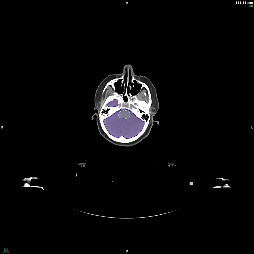 Automatic Contouring/Segmentation Demo
