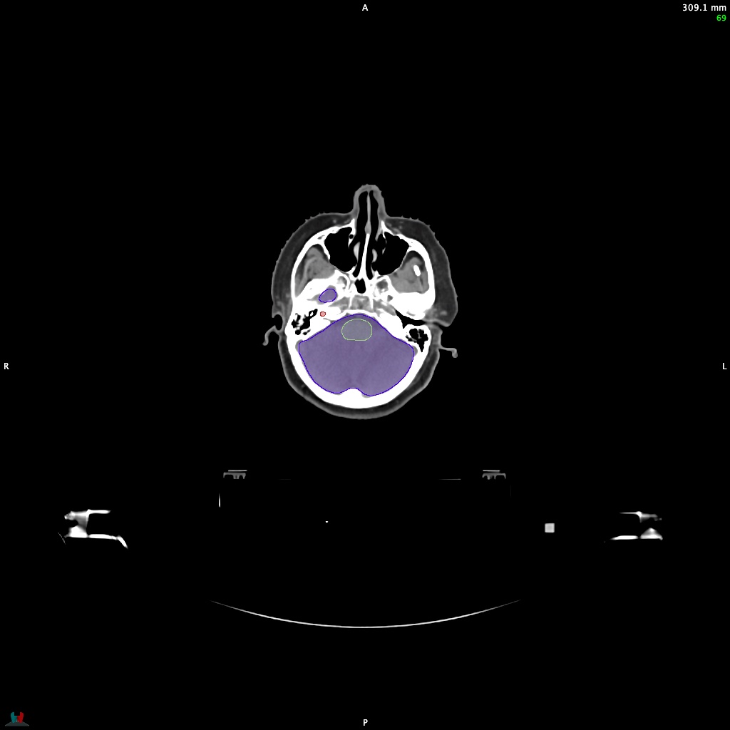 Automatic Contouring/Segmentation Demo