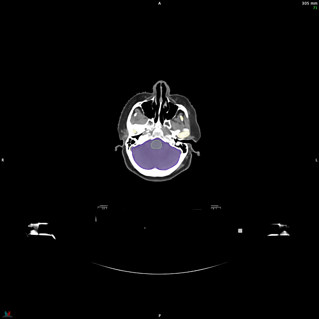 Automatic Contouring/Segmentation Demo