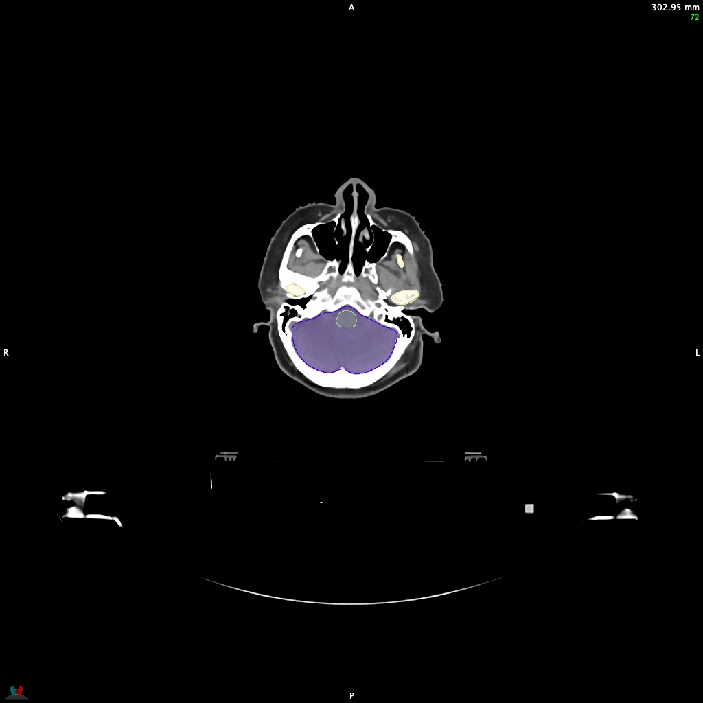 Automatic Contouring/Segmentation Demo