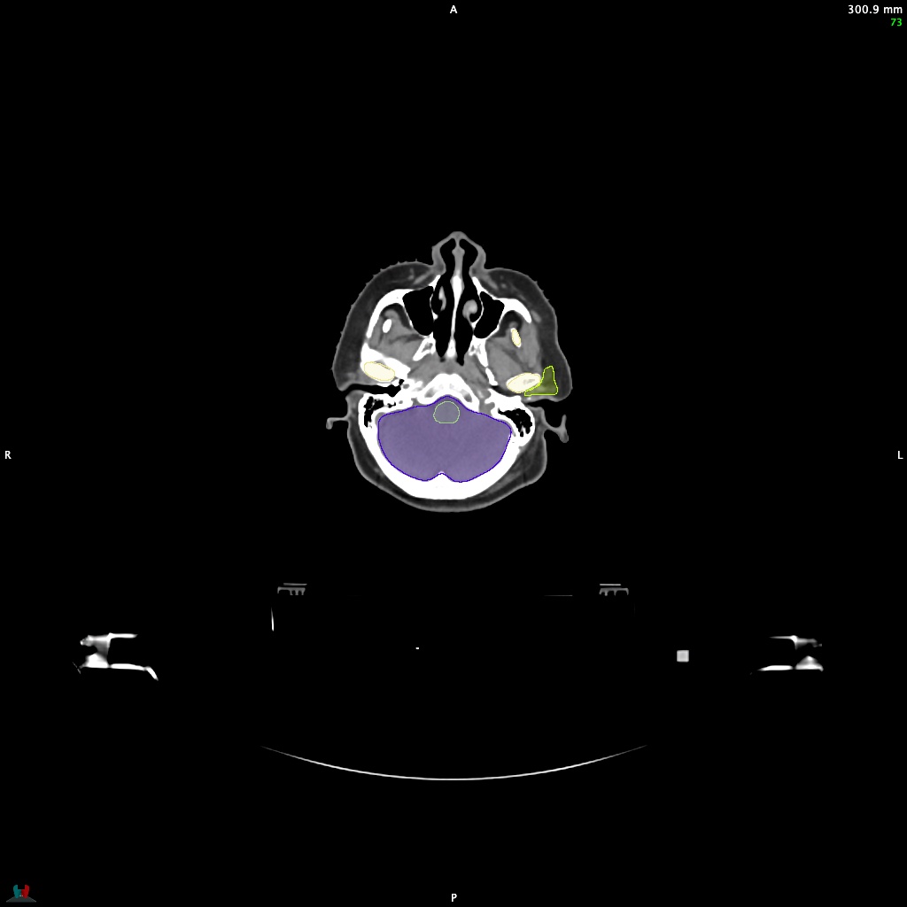 Automatic Contouring/Segmentation Demo