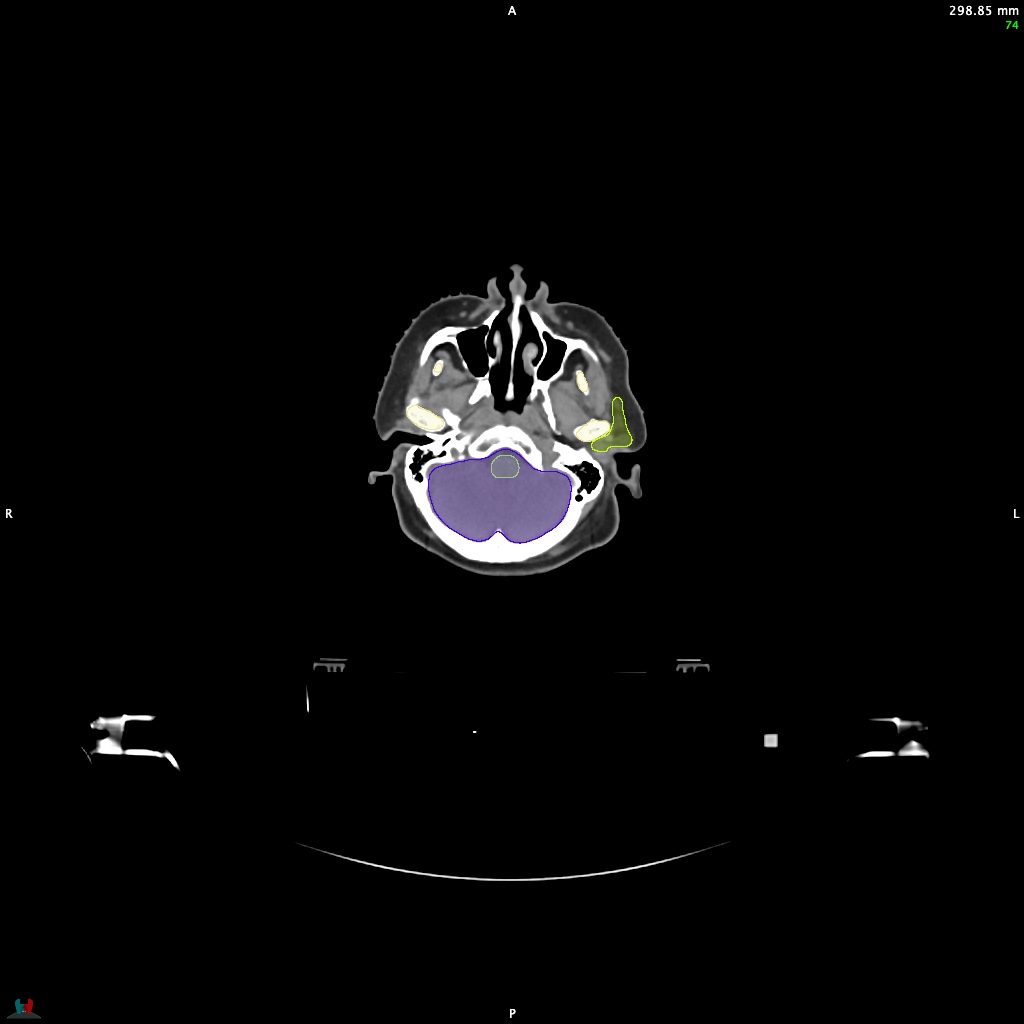Automatic Contouring/Segmentation Demo