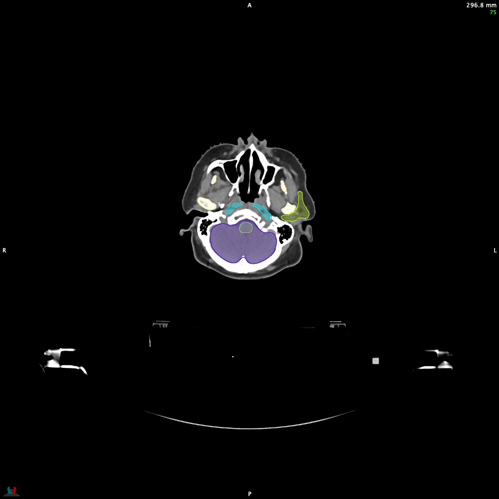 Automatic Contouring/Segmentation Demo