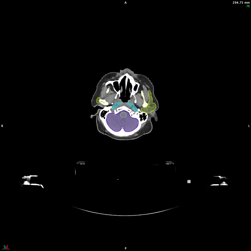 Automatic Contouring/Segmentation Demo