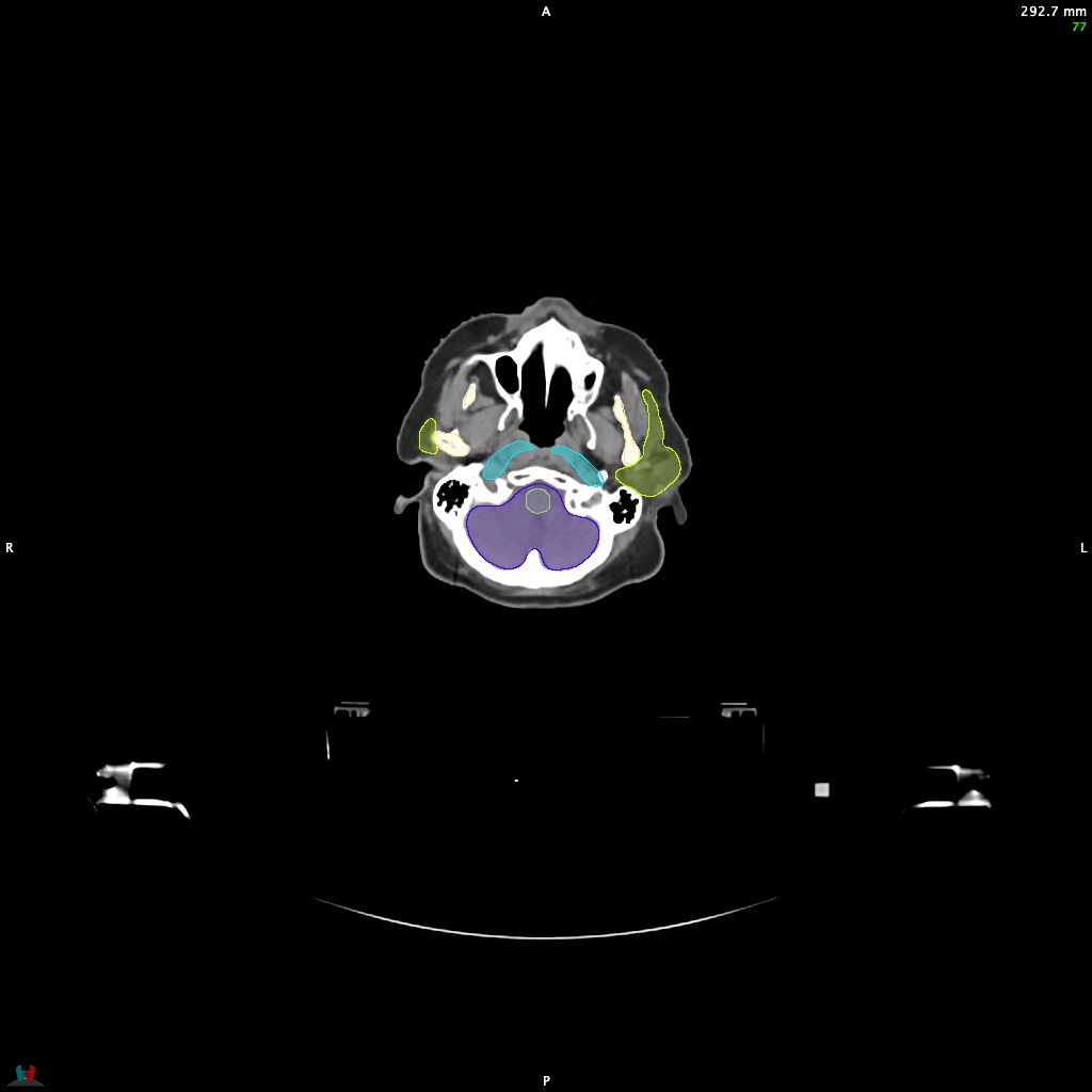 Automatic Contouring/Segmentation Demo