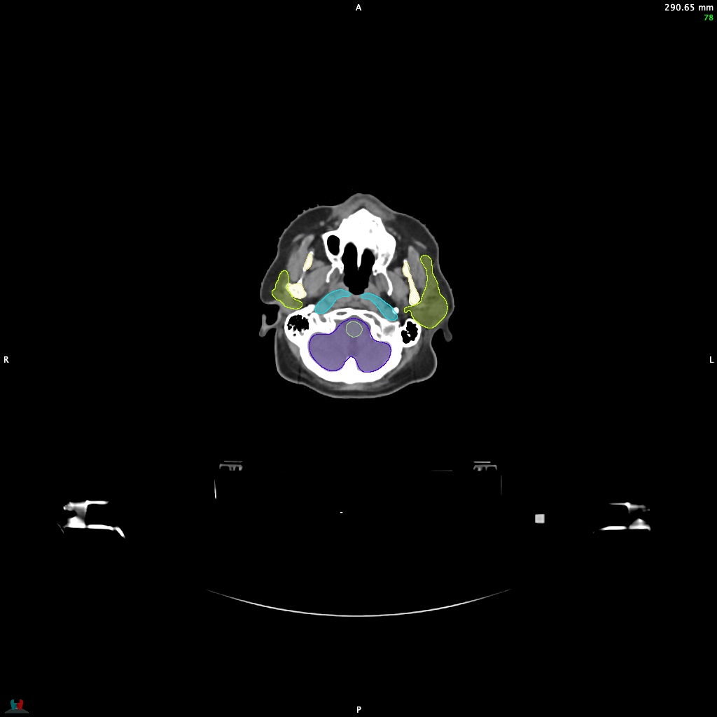 Automatic Contouring/Segmentation Demo