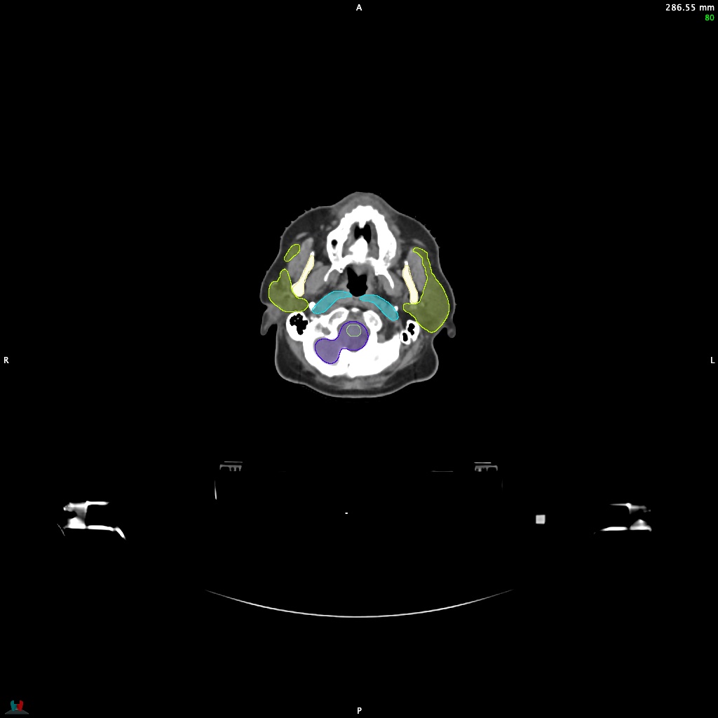 Automatic Contouring/Segmentation Demo