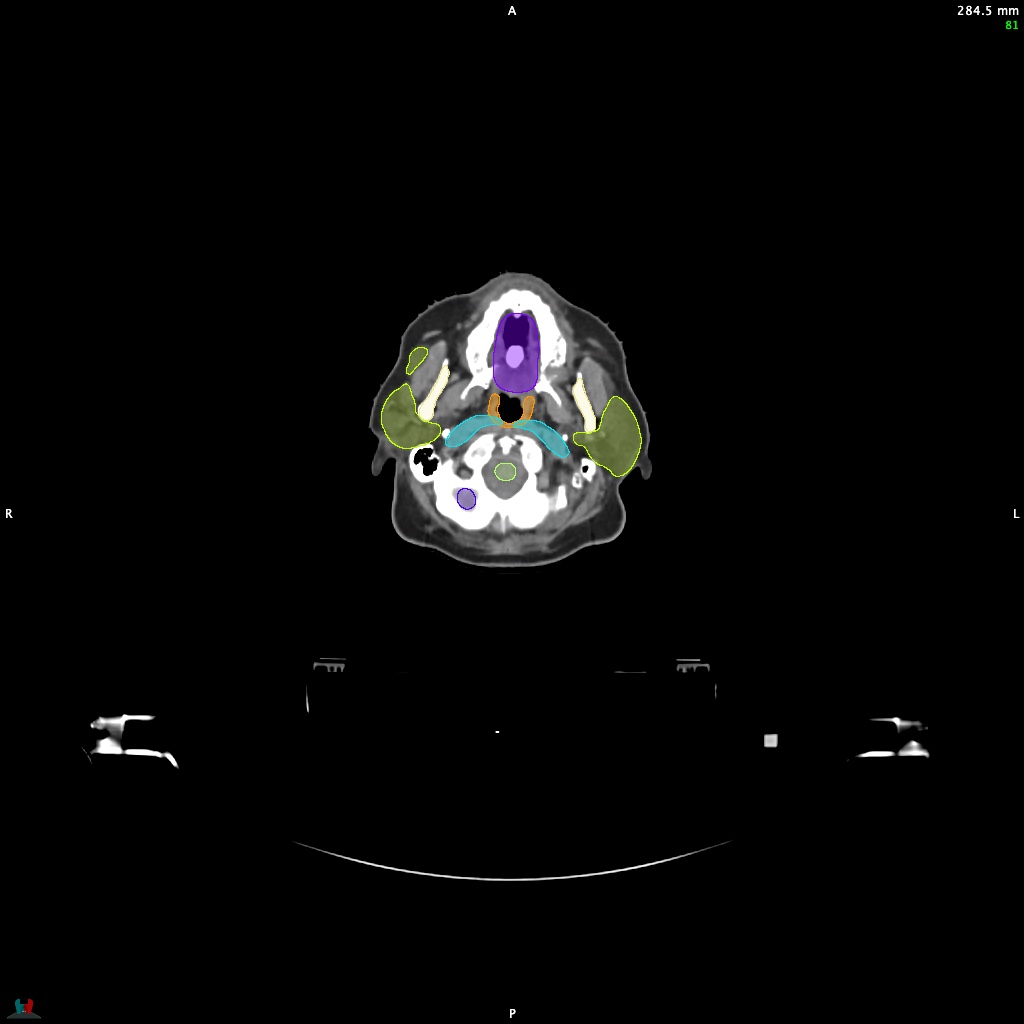 Automatic Contouring/Segmentation Demo