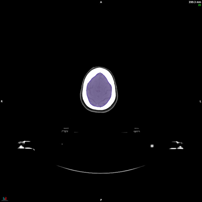 Automatic Contouring/Segmentation Demo