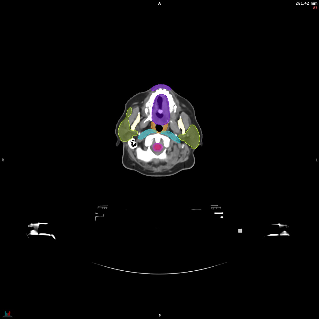 Automatic Contouring/Segmentation Demo
