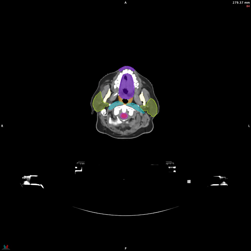 Automatic Contouring/Segmentation Demo