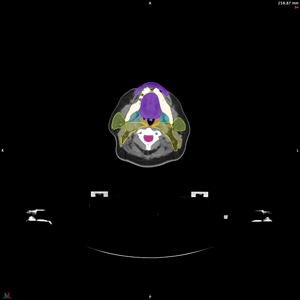 Automatic Contouring/Segmentation Demo