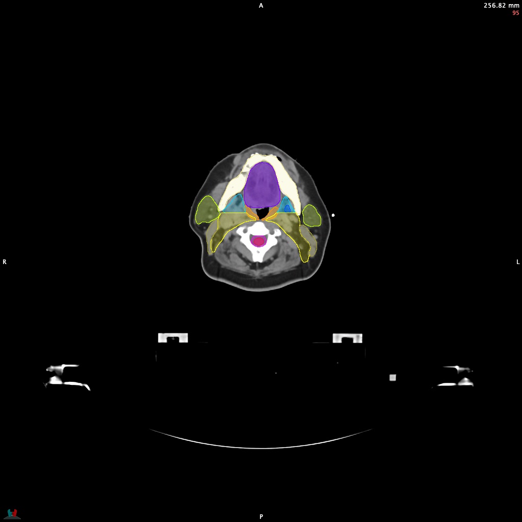 Automatic Contouring/Segmentation Demo