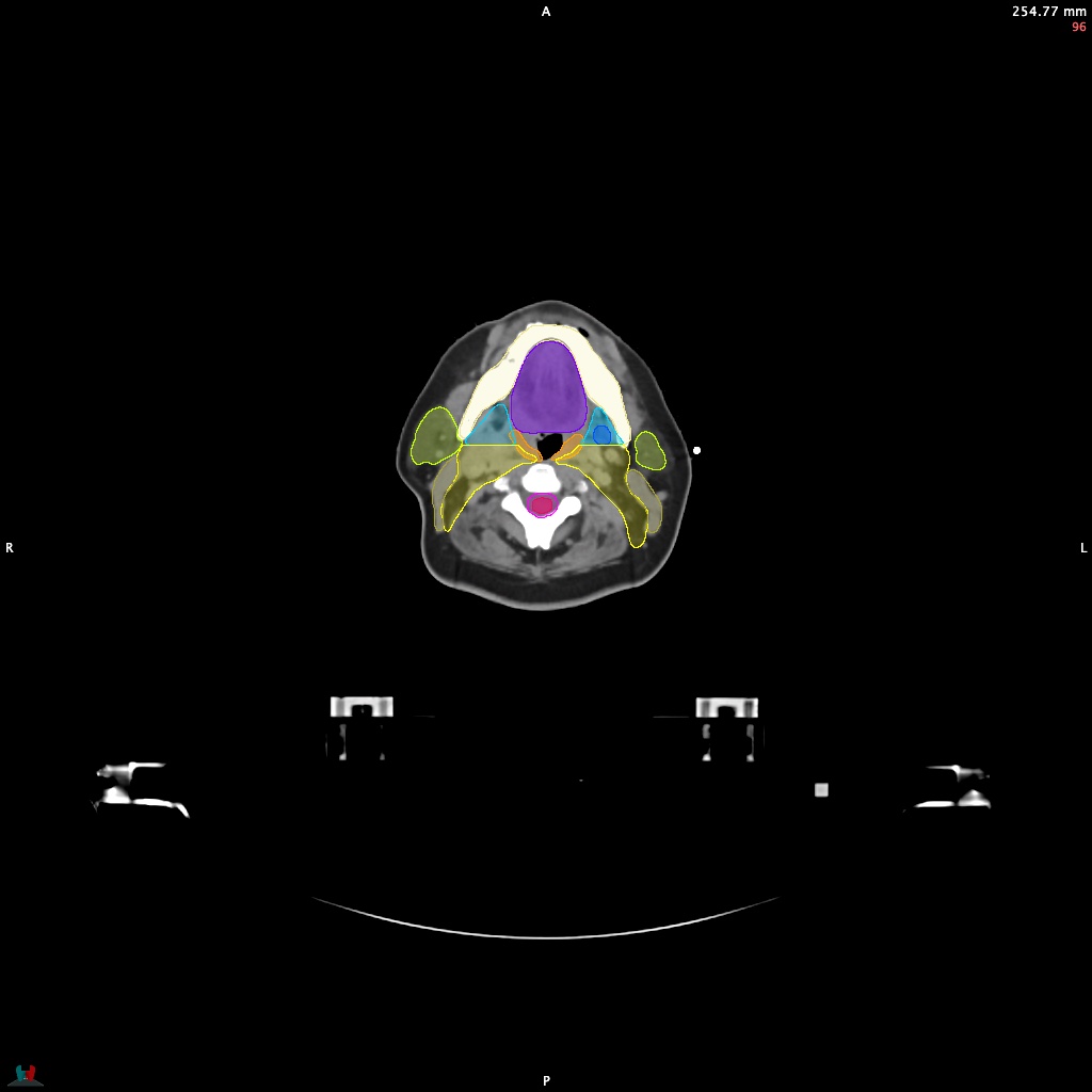 Automatic Contouring/Segmentation Demo