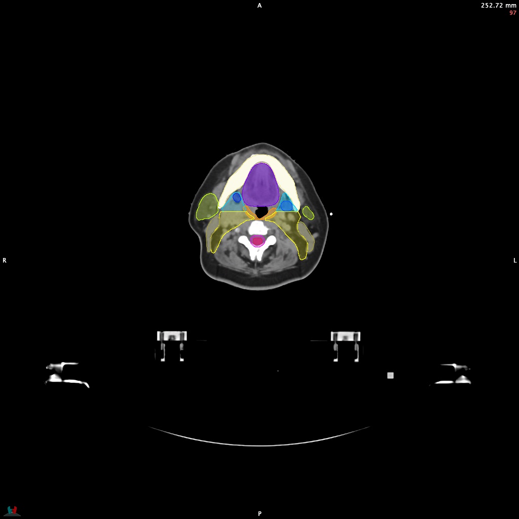 Automatic Contouring/Segmentation Demo