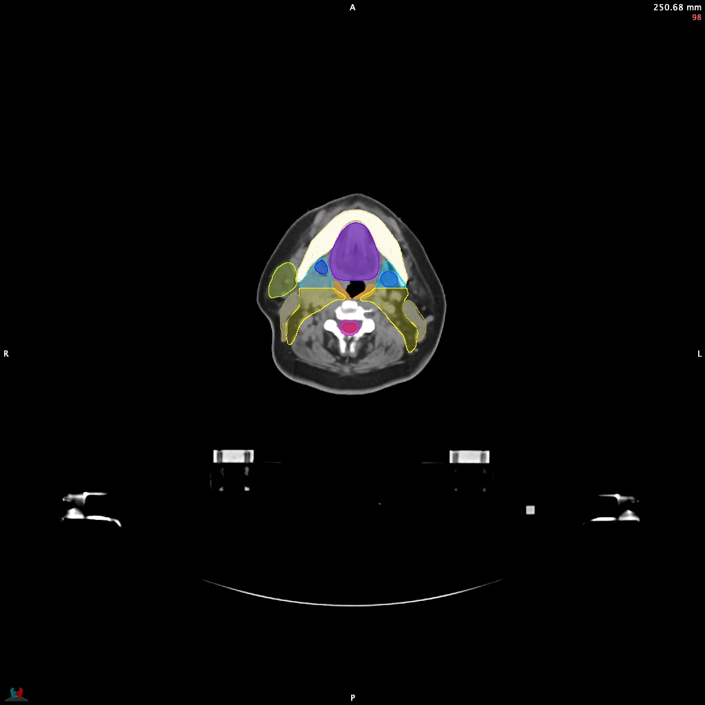Automatic Contouring/Segmentation Demo