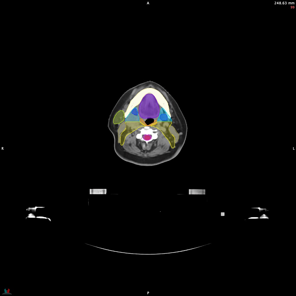Automatic Contouring/Segmentation Demo